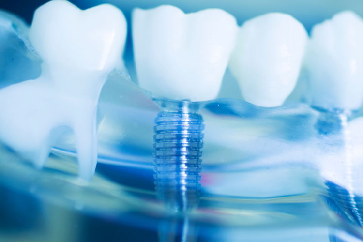 dental implants in bradford ontario