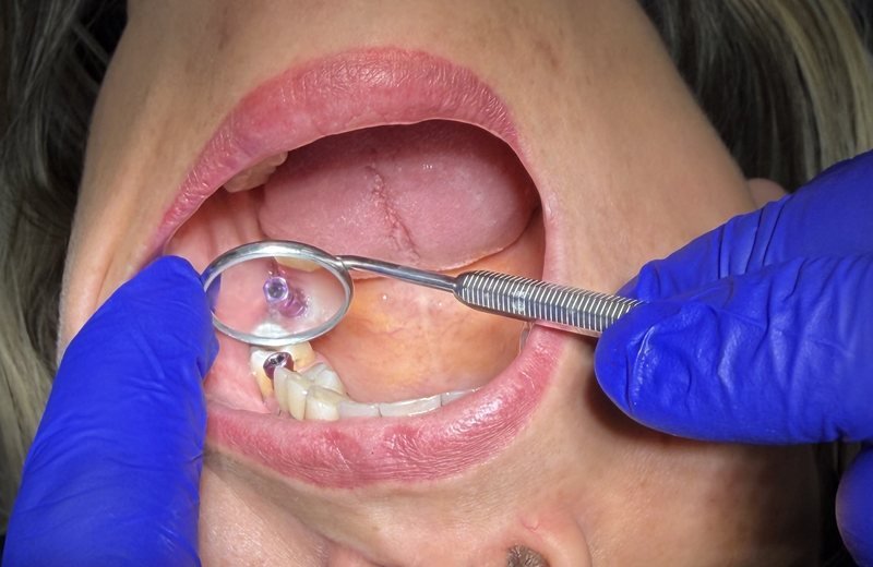 Dental implant treatment at Hola Dentistry in Bradford