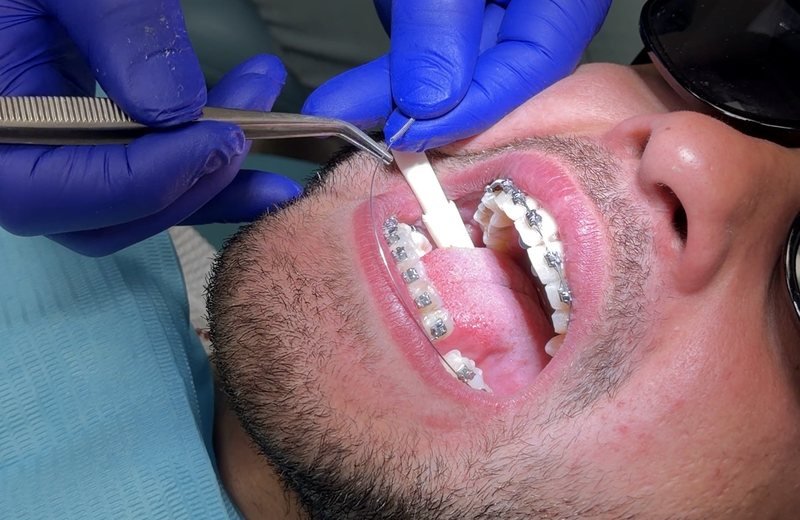 Orthodontic braces treatment at Hola Dentistry in Bradford