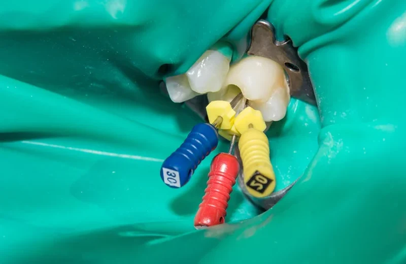 Bradford dentist performing a gentle, pain-free root canal treatment using modern endodontic instruments