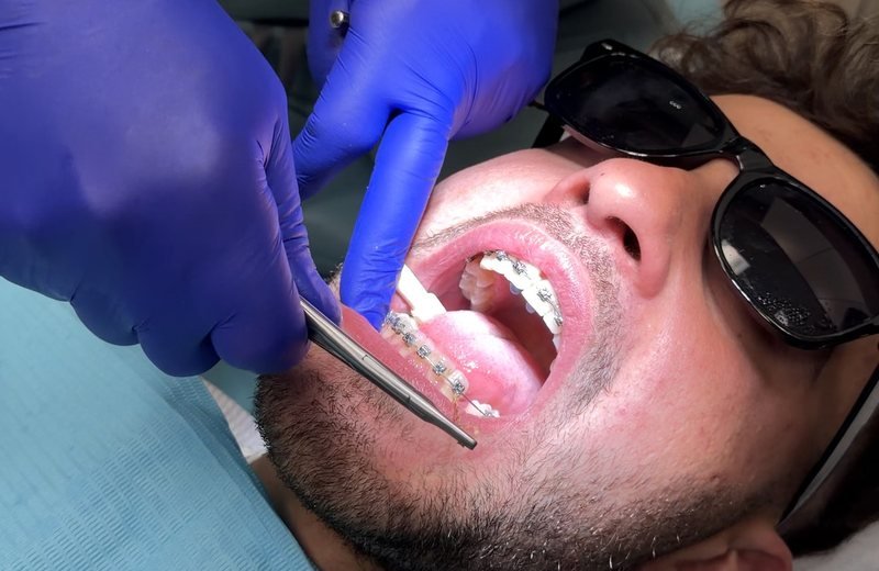 Dental braces consultation and treatment at Hola Dentistry in Bradford